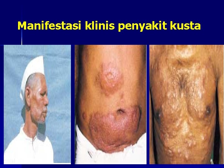 Manifestasi klinis penyakit kusta 
