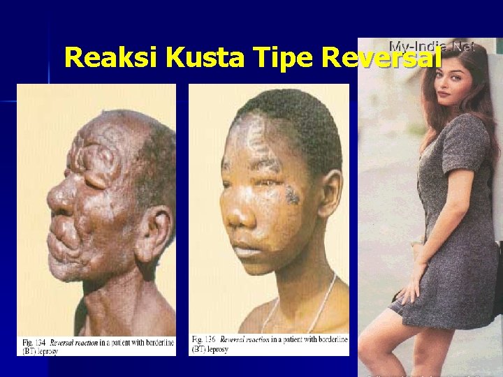 Reaksi Kusta Tipe Reversal 