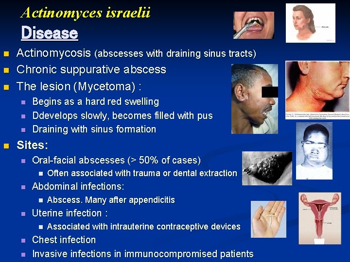 Actinomyces israelii Disease n n n Actinomycosis (abscesses with draining sinus tracts) Chronic suppurative