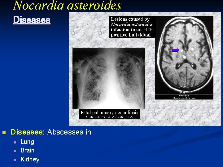 Nocardia asteroides Diseases n Diseases: Abscesses in: n n n Lung Brain Kidney 