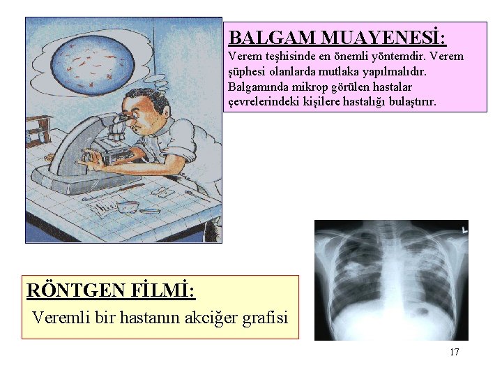 BALGAM MUAYENESİ: Verem teşhisinde en önemli yöntemdir. Verem şüphesi olanlarda mutlaka yapılmalıdır. Balgamında mikrop