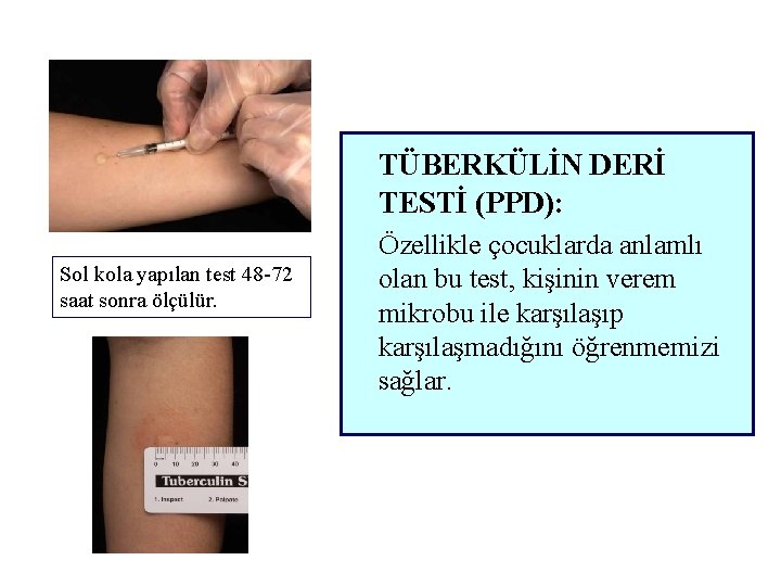 TÜBERKÜLİN DERİ TESTİ (PPD): Sol kola yapılan test 48 -72 saat sonra ölçülür. Özellikle