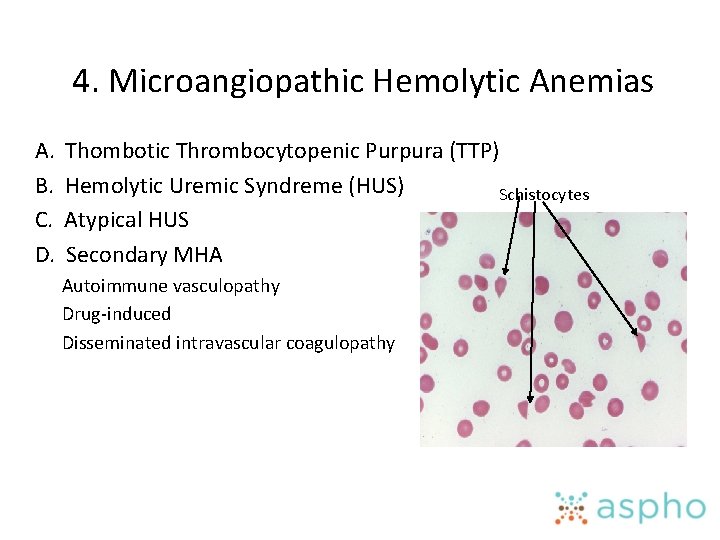 4. Microangiopathic Hemolytic Anemias A. Thombotic Thrombocytopenic Purpura (TTP) B. Hemolytic Uremic Syndreme (HUS)