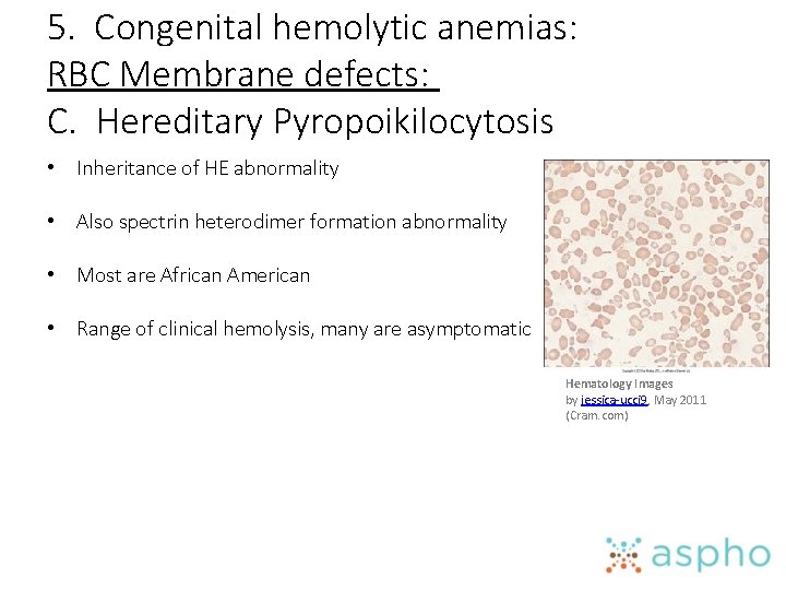 5. Congenital hemolytic anemias: RBC Membrane defects: C. Hereditary Pyropoikilocytosis • Inheritance of HE