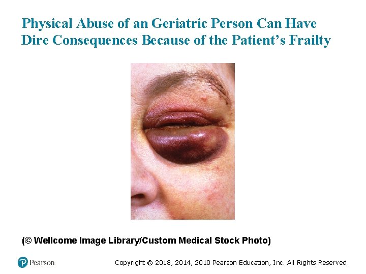 Physical Abuse of an Geriatric Person Can Have Dire Consequences Because of the Patient’s