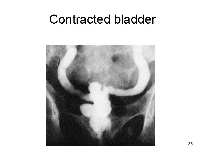 Contracted bladder 33 