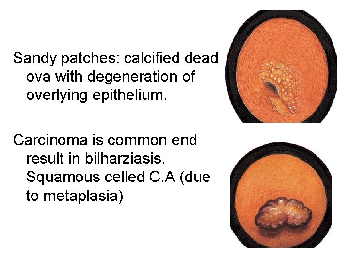 Sandy patches: calcified dead ova with degeneration of overlying epithelium. Carcinoma is common end