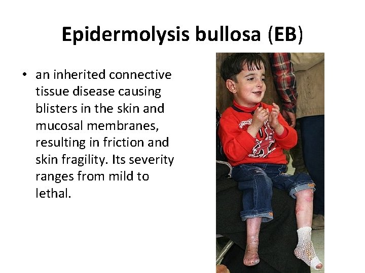 Epidermolysis bullosa (EB) • an inherited connective tissue disease causing blisters in the skin