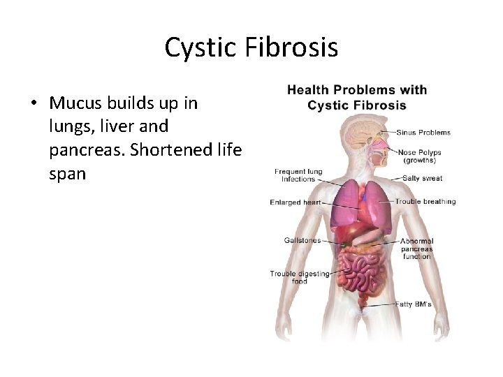 Cystic Fibrosis • Mucus builds up in lungs, liver and pancreas. Shortened life span