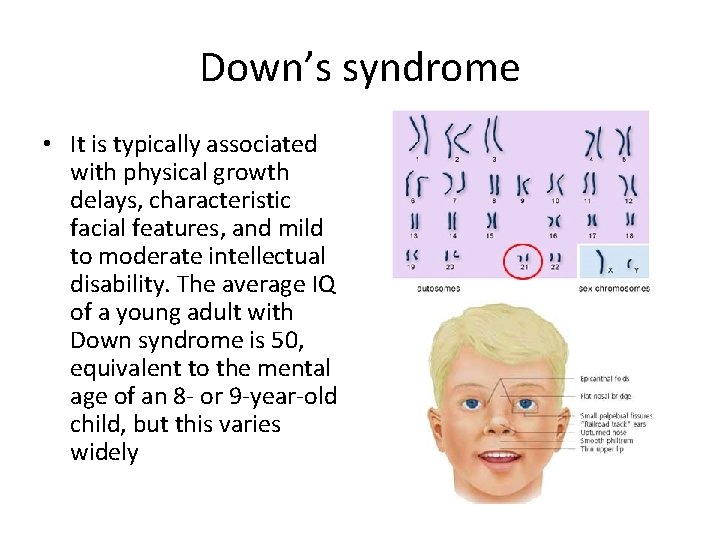 Down’s syndrome • It is typically associated with physical growth delays, characteristic facial features,