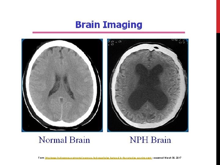 From: http: //www. hydroassoc. org/normal-pressure-hydrocephalus-featured-in-the-saturday-evening-post/ ; accessed March 30, 2017 From: http: //www. hydroassoc. org/normal-pressure-hydrocephalus-featured-in-the-saturday-evening-post/ ; accessed March 30, 2017