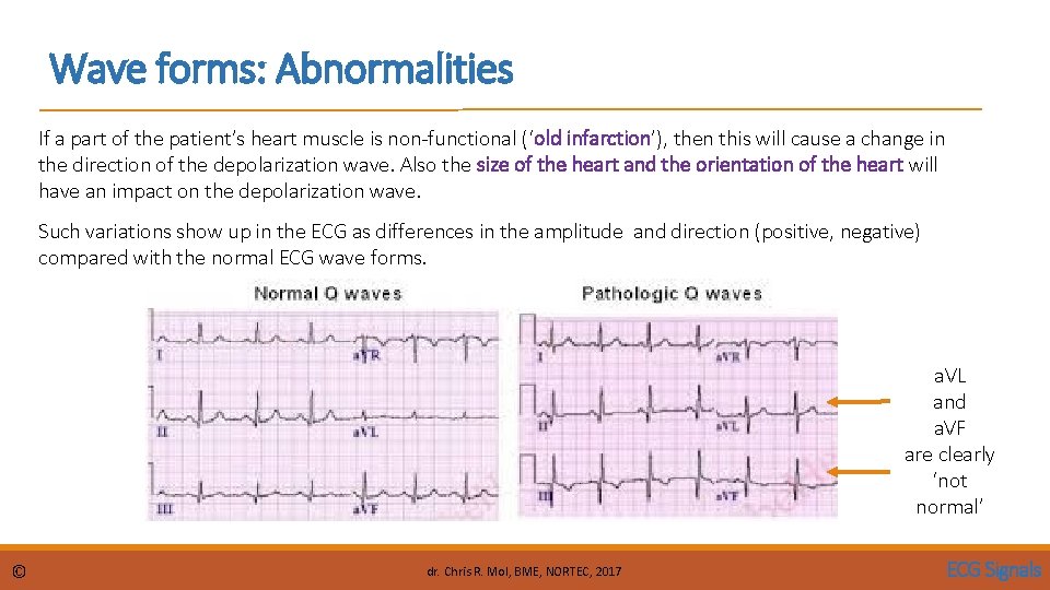 Wave forms: Abnormalities If a part of the patient’s heart muscle is non-functional (‘old