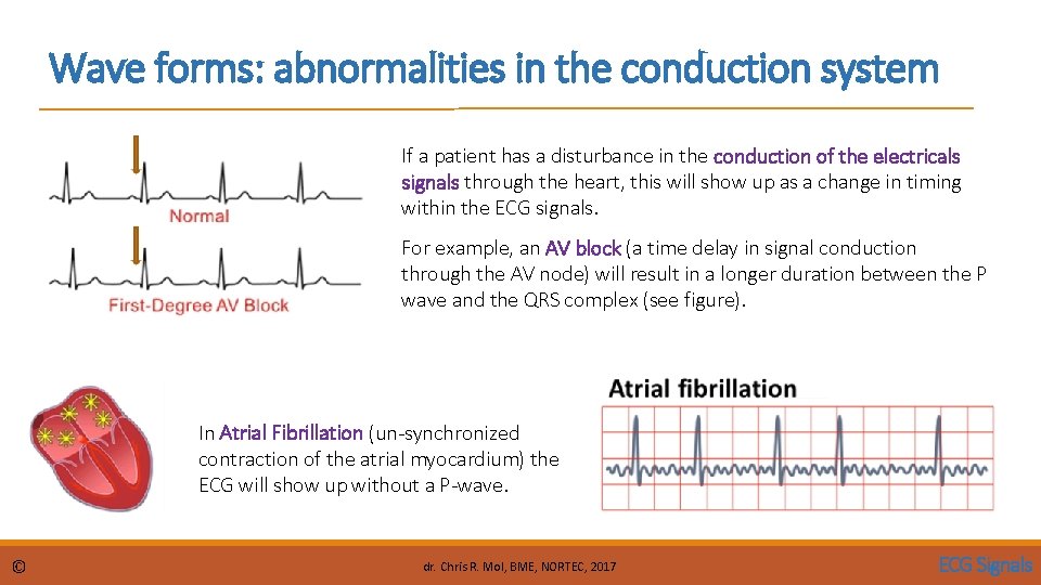 Wave forms: abnormalities in the conduction system If a patient has a disturbance in
