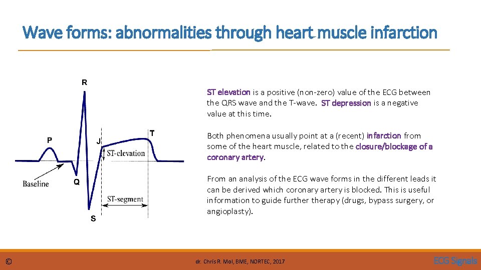 Wave forms: abnormalities through heart muscle infarction ST elevation is a positive (non-zero) value