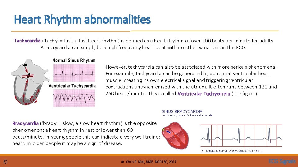 Heart Rhythm abnormalities Tachycardia (‘tachy’ = fast, a fast heart rhythm) is defined as