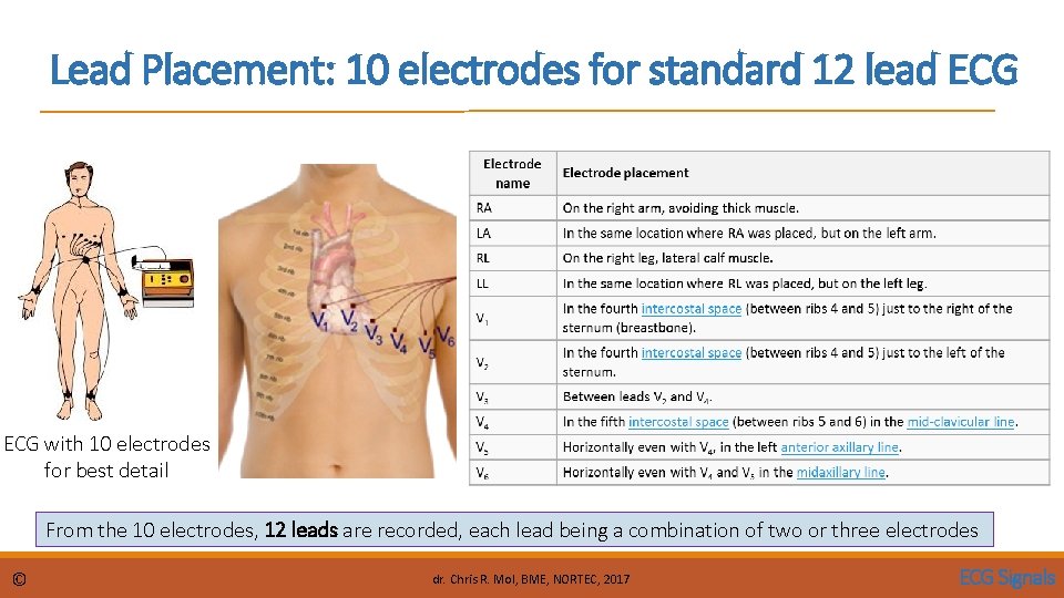 Lead Placement: 10 electrodes for standard 12 lead ECG with 10 electrodes for best