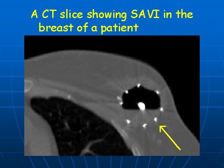 A CT slice showing SAVI in the breast of a patient 