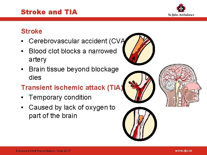 Stroke and TIA Stroke • Cerebrovascular accident (CVA) • Blood clot blocks a narrowed