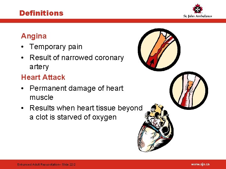 Definitions Angina • Temporary pain • Result of narrowed coronary artery Heart Attack •