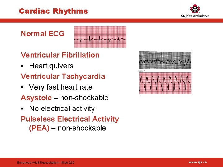 Cardiac Rhythms Normal ECG Ventricular Fibrillation • Heart quivers Ventricular Tachycardia • Very fast