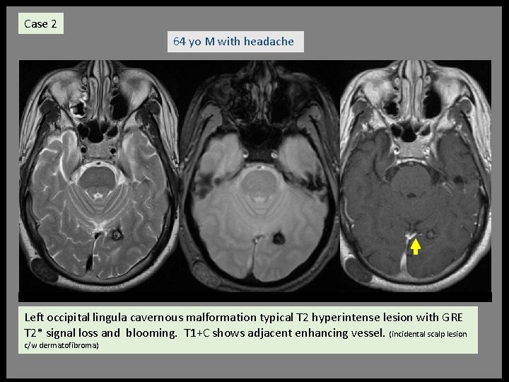 Case 2 64 yo M with headache Left occipital lingula cavernous malformation typical T