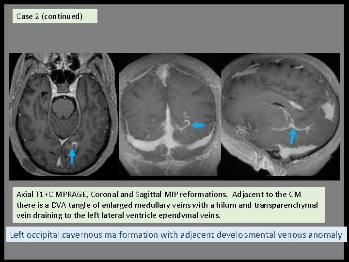 Case 2 (continued) Axial T 1+C MPRAGE, Coronal and Sagittal MIP reformations. Adjacent to