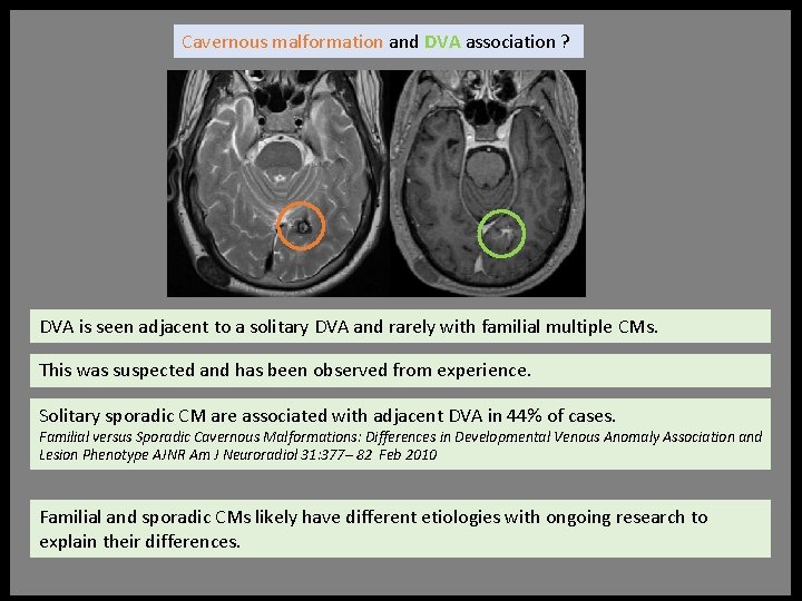 Cavernous malformation and DVA association ? DVA is seen adjacent to a solitary DVA