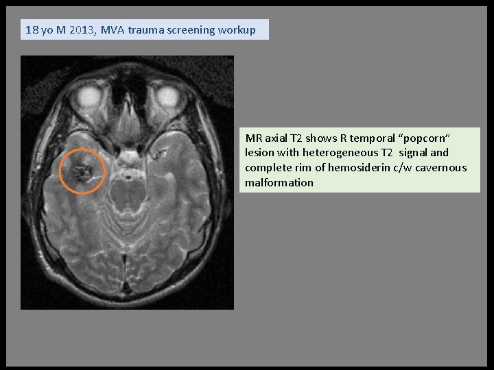 18 yo M 2013, MVA trauma screening workup MR axial T 2 shows R