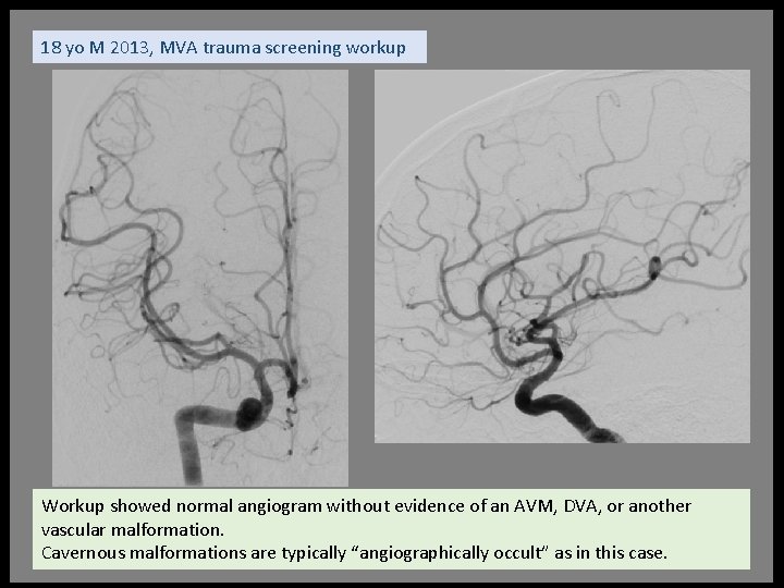 18 yo M 2013, MVA trauma screening workup Workup showed normal angiogram without evidence