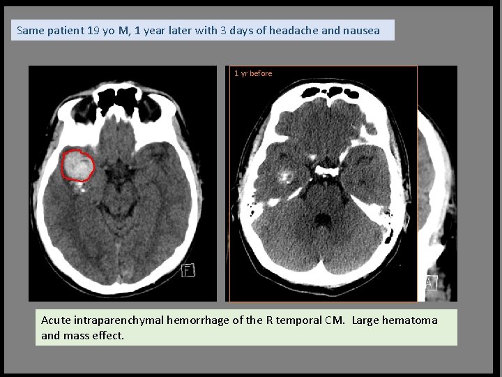 Same patient 19 yo M, 1 year later with 3 days of headache and