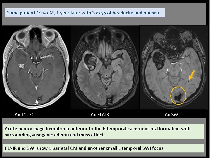 Same patient 19 yo M, 1 year later with 3 days of headache and