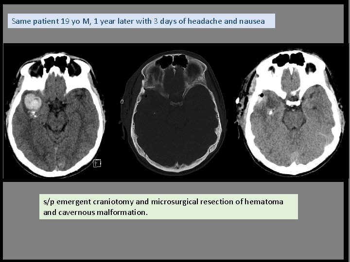 Same patient 19 yo M, 1 year later with 3 days of headache and