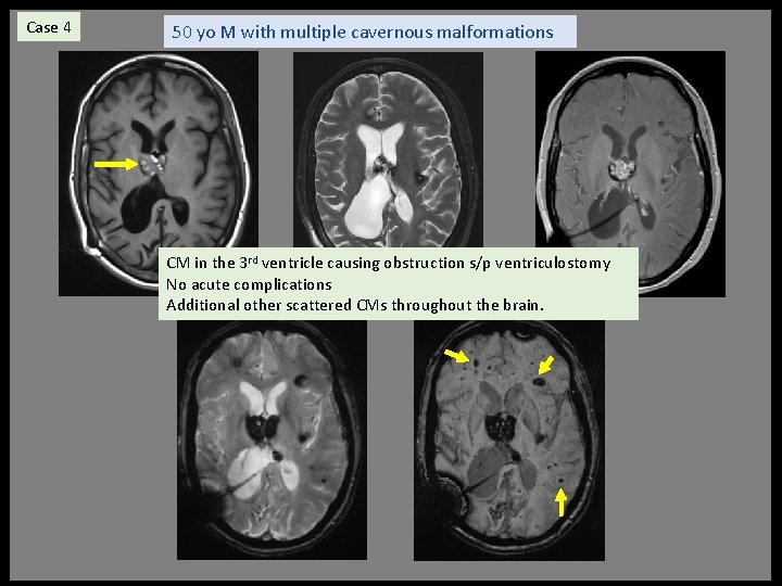 Case 4 50 yo M with multiple cavernous malformations CM in the 3 rd