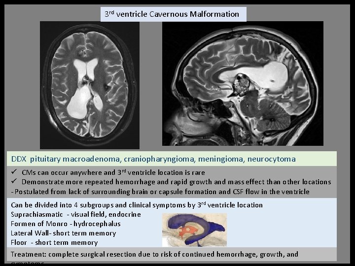 3 rd ventricle Cavernous Malformation DDX pituitary macroadenoma, craniopharyngioma, meningioma, neurocytoma ü CMs can