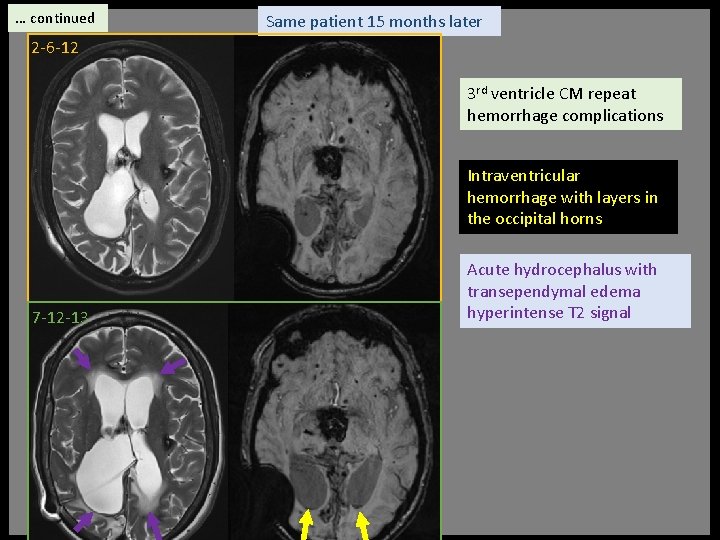 … continued Same patient 15 months later 2 -6 -12 3 rd ventricle CM