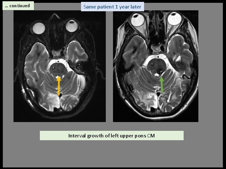 … continued Same patient 1 year later Interval growth of left upper pons CM