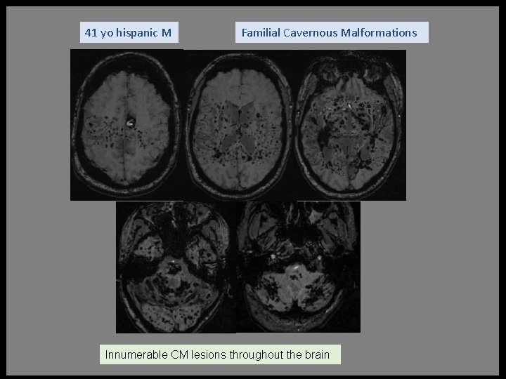 41 yo hispanic M Familial Cavernous Malformations Innumerable CM lesions throughout the brain 