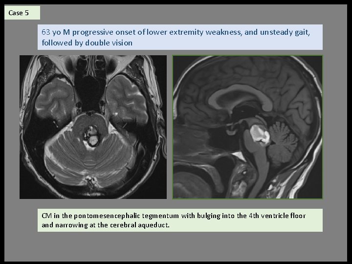 Case 5 63 yo M progressive onset of lower extremity weakness, and unsteady gait,