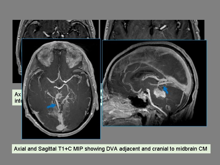Ax T 1+C demonstrates a DVA cranial to the CM with draining collector veins
