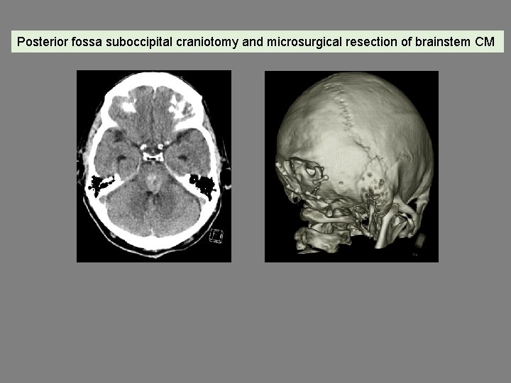 Posterior fossa suboccipital craniotomy and microsurgical resection of brainstem CM 