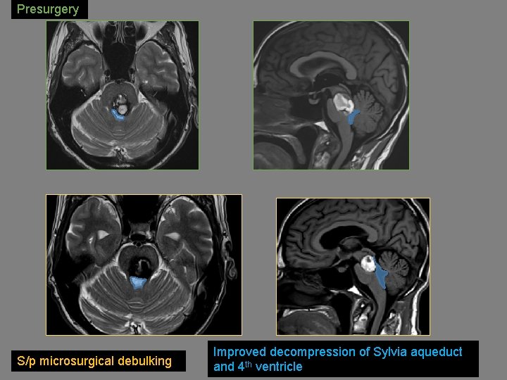 Presurgery S/p microsurgical debulking Improved decompression of Sylvia aqueduct and 4 th ventricle 