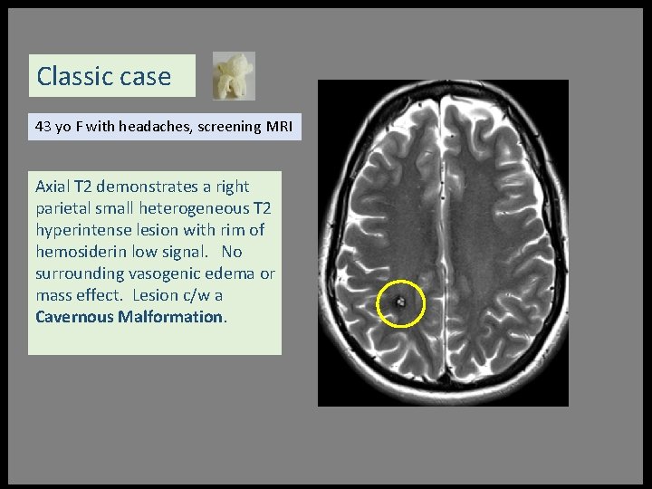 Classic case 43 yo F with headaches, screening MRI Axial T 2 demonstrates a