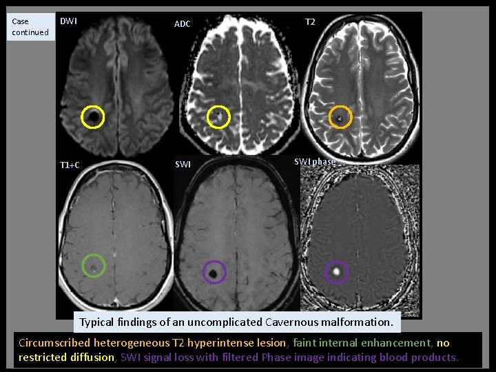 Case continued DWI ADC T 1+C SWI T 2 SWI phase Typical findings of