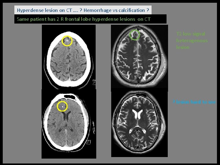 Hyperdense lesion on CT …. ? Hemorrhage vs calcification ? Same patient has 2