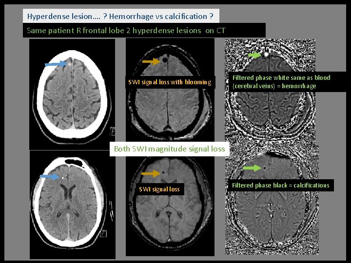 Hyperdense lesion…. ? Hemorrhage vs calcification ? Same patient R frontal lobe 2 hyperdense