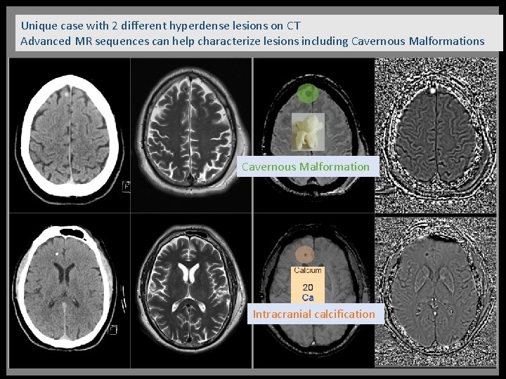 Unique case with 2 different hyperdense lesions on CT Advanced MR sequences can help