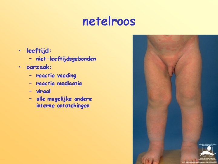 netelroos • leeftijd: – niet-leeftijdsgebonden • oorzaak: – – reactie voeding reactie medicatie viraal