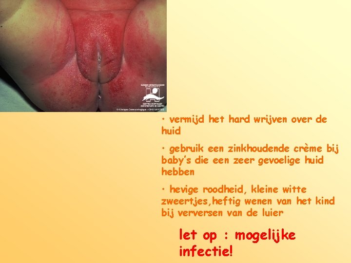  • vermijd het hard wrijven over de huid • gebruik een zinkhoudende crème