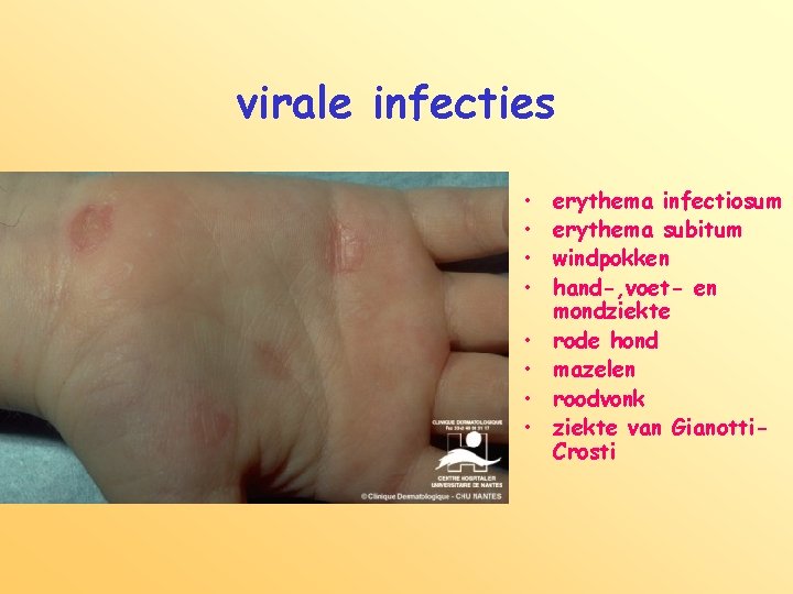 virale infecties • • erythema infectiosum erythema subitum windpokken hand-, voet- en mondziekte rode