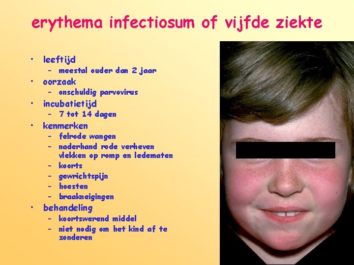 erythema infectiosum of vijfde ziekte • leeftijd • oorzaak • incubatietijd • kenmerken •